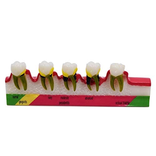 GEEFSU-Tooth Classification Demonstration Model Show Oral Dental Structure - for The Teaching Demonstration of Periodontology