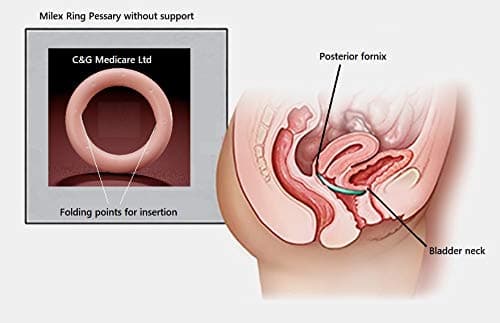 Milex Folding Ring Pessary Without Support (83mm)