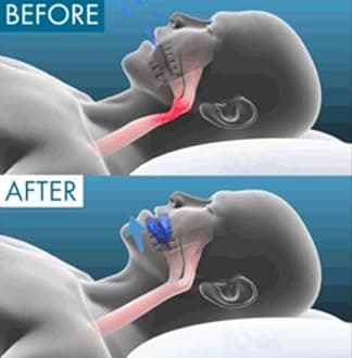 Anti Snoring Mouthpiece, The Quiet Anti-Snoring Mouthpiece Universal Size, Mouth Guard for Sleep Apnea & Instant Snoring Relief, Ensure Deep and Calm Sleep, Wake up Refreshed (3Pcs)