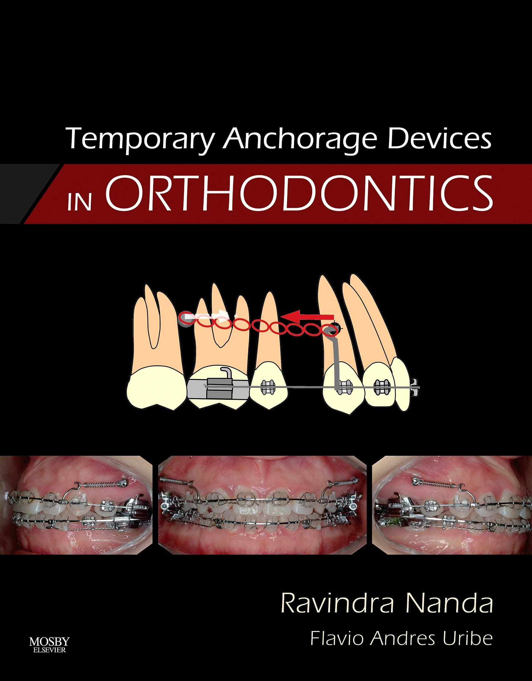 Temporary Anchorage Devices in Orthodontics 1st Edition